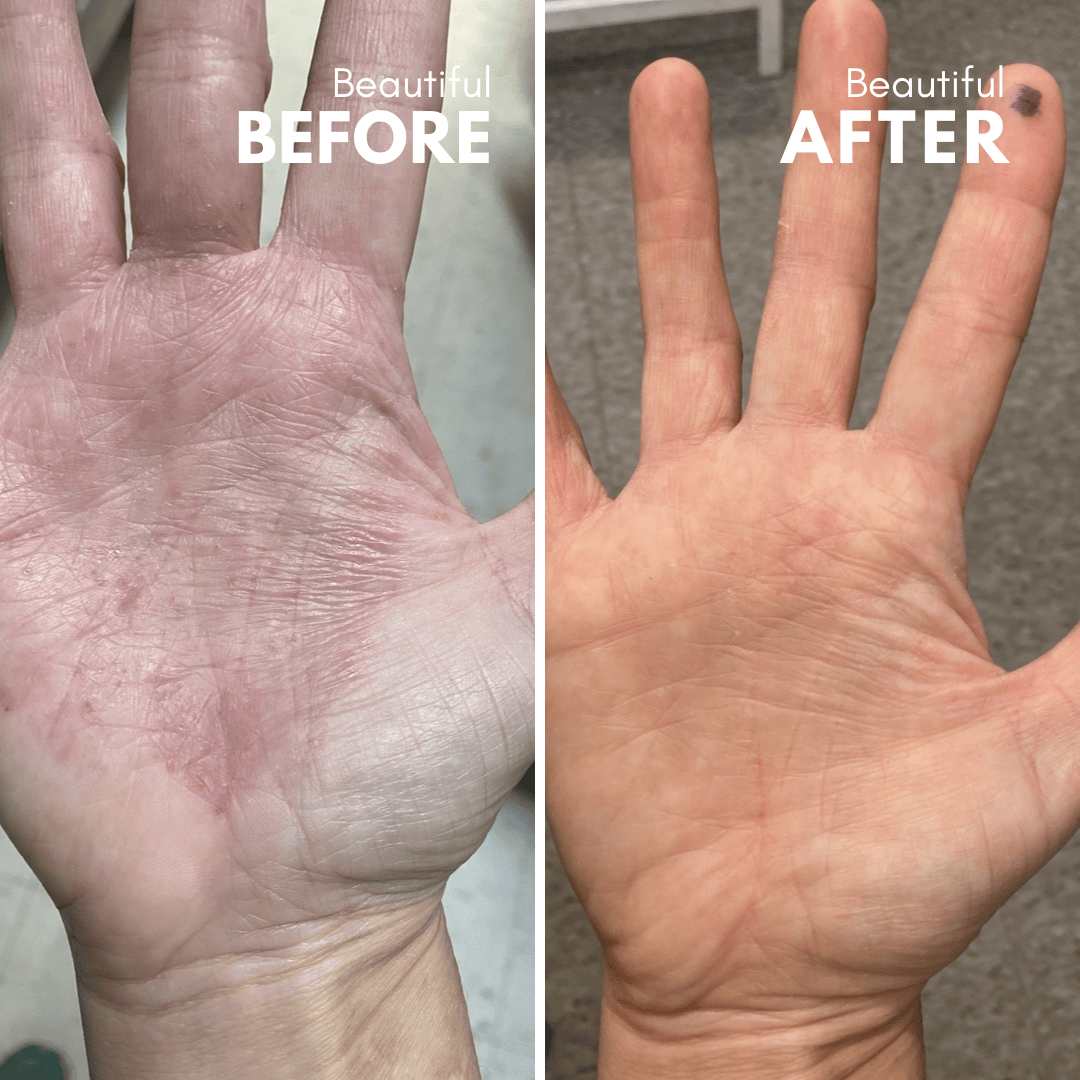 Trivolos | Eczema Cream