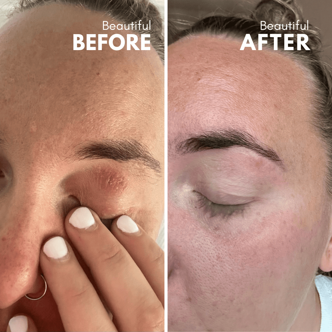 Trivolos | Eczema Cream